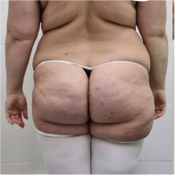 Endo-One Clinical results - before
