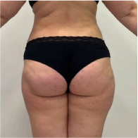 Endo-One Clinical results - after