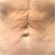 Endo-One Clinical results - before