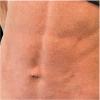 Endo-One Clinical results - after