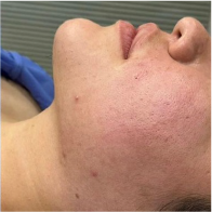 Endo-One Clinical results - after