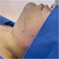 Endo-One Clinical results - before