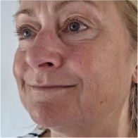Endo-One Clinical results - before