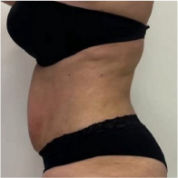 Endo-One Clinical results - after