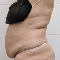 Endo-One Clinical results - before