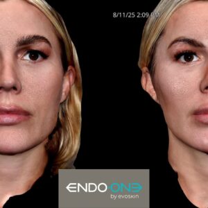 Complete Guide to Laser Skin Treatments in Miami: What to Expect Before & After