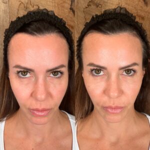 Plasma Gel vs. PRP: Clinical Insights into the New Wave of Regenerative Skin Therapy