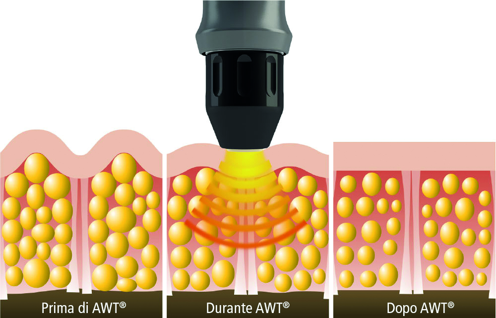 Diagram of acoustic wave therapy effect on tissue before, during and after AWT