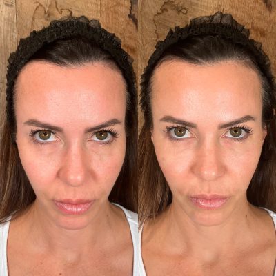 64e634a30fe05b1f8af4118e_PRF EZ Gel (under eyes and nasolabial folds) (2)