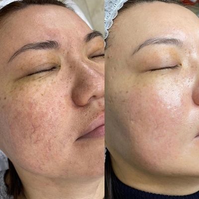 Laser-Resurfacing-before-after-6