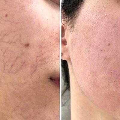Vascular-Lesions-Treatment-before-after